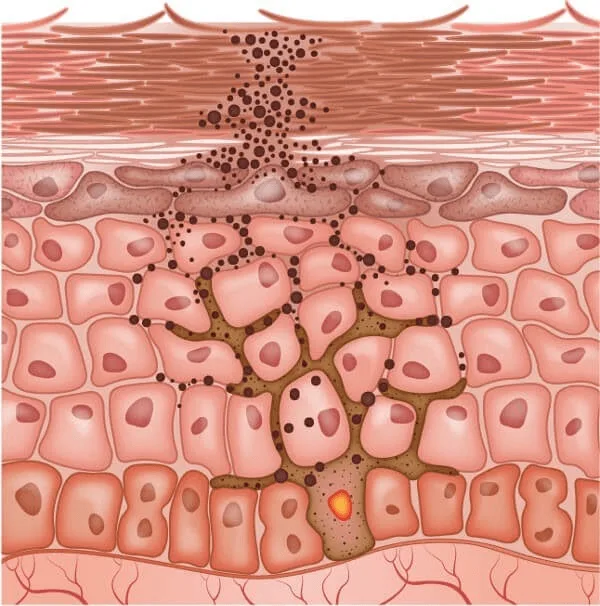 Nám chân đinh ở dưới lớp trung bì của làn da