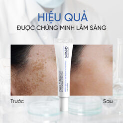 ăn gì để chữa nám kháng trị