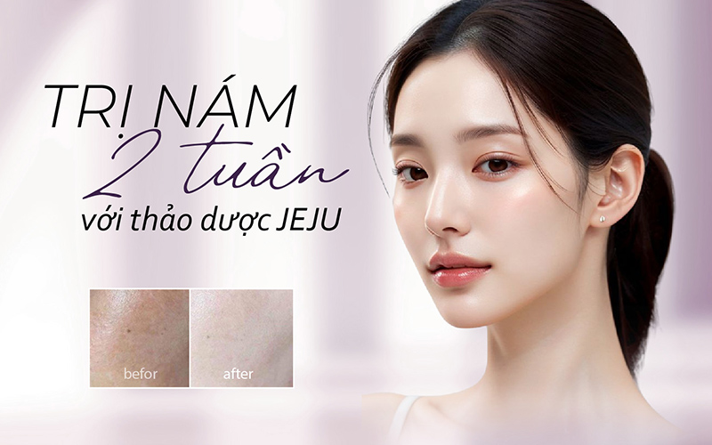 Trị nám bằng thảo dược jeju