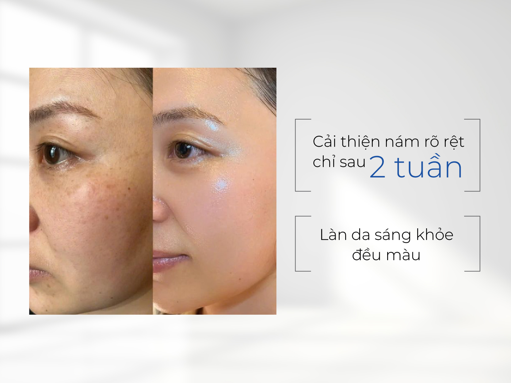 SkinMD – khi bảng thành phần được thiết kế vì làn da nám kháng trị