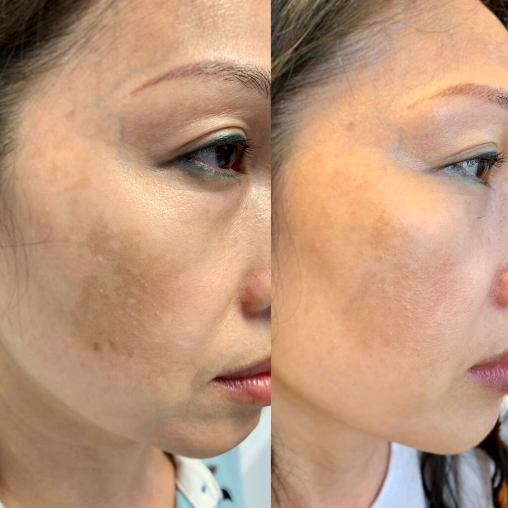 Chị N.M.H(42 tuổi, Hà Nội) bị nám kháng trị, chữa nhiều năm tại nhiều cơ sở da liễu mà không khỏi (hình ảnh trước và sau khi dùng SkinMD do bác sĩ da liễu chỉ định)