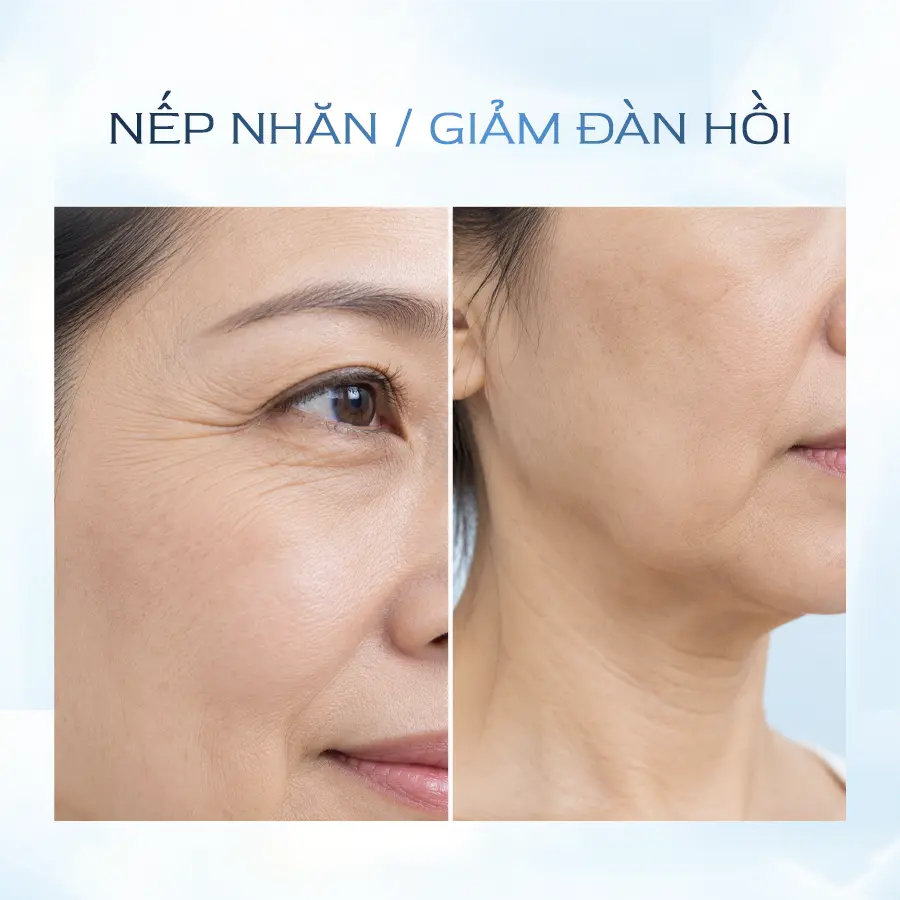 Nep Nhan Giam Dan Hoi Da Sau 45 Tuoi